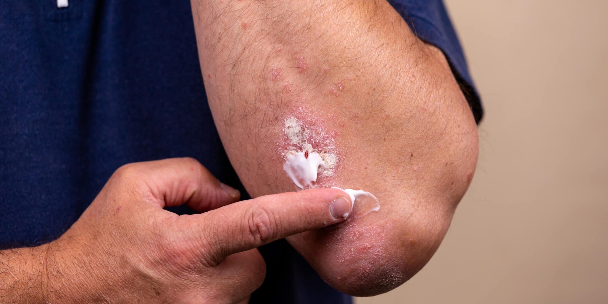 autoimunitné ochorenia