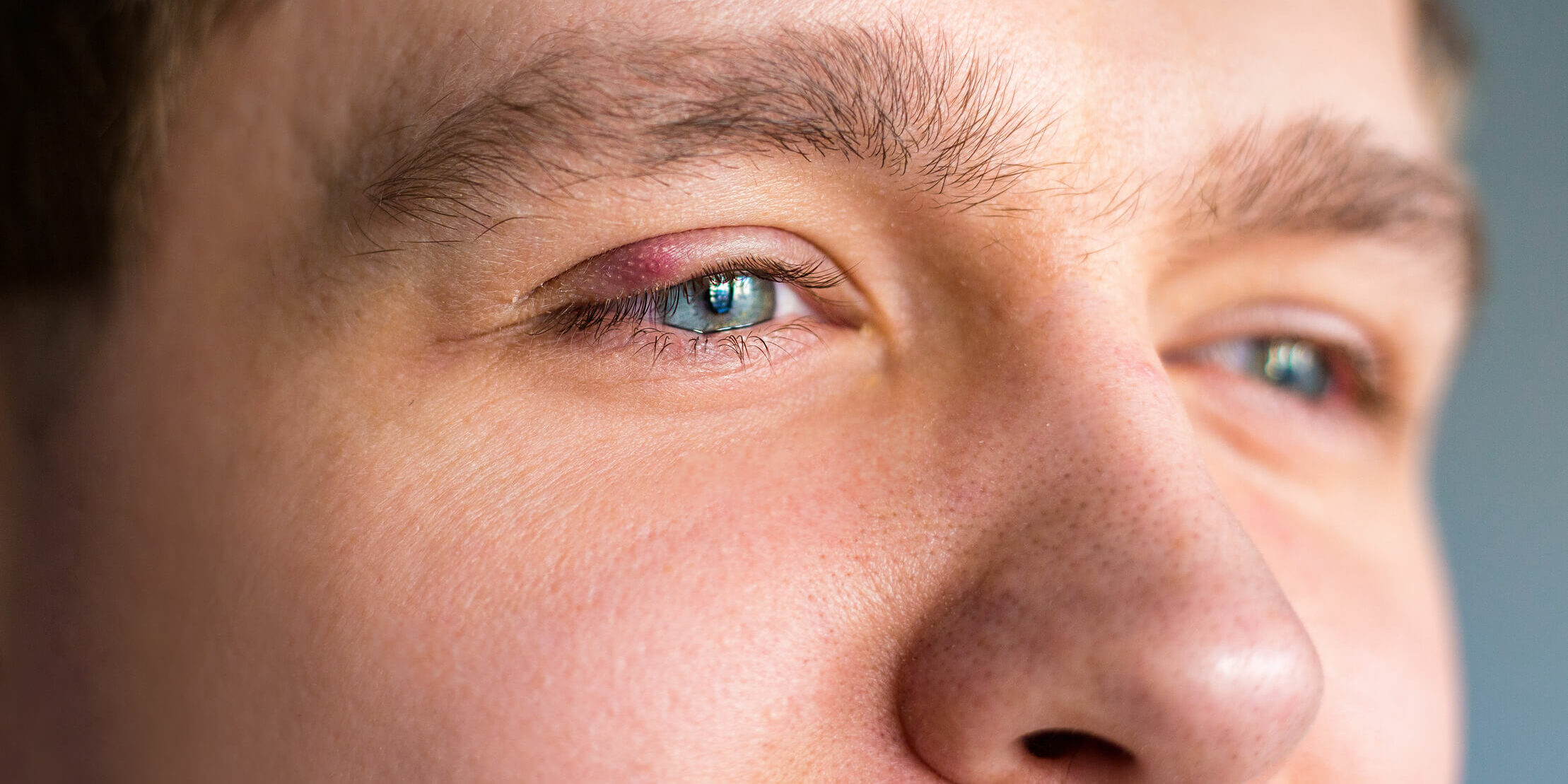 jacmen-v-oku jačmeň v oku